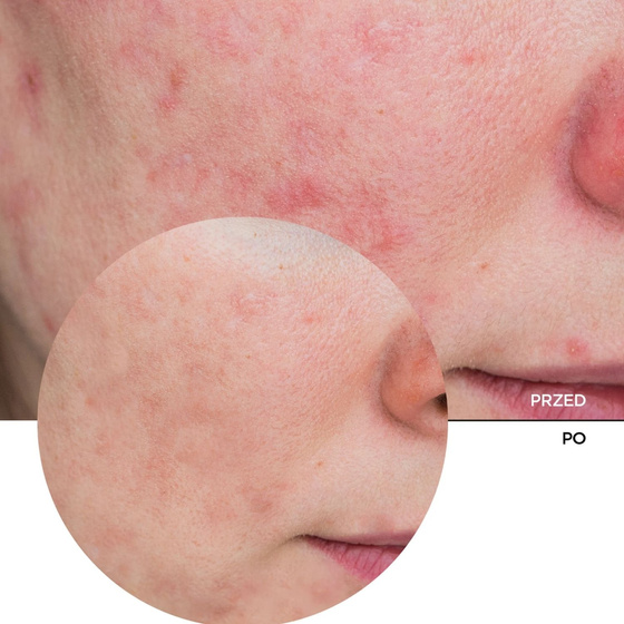 Revox B77 Just Azelaic Acid 10% Brightening Solution — осветляющий крем для лица с 10% азелаиновой кислотой, 30 мл